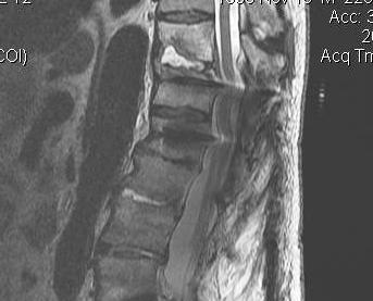 MRI Gadolinium Post Operative Discitis T2